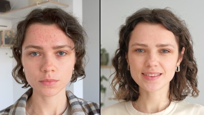 acne-:-mieux-comprendre-les-causes-pour-s’en-debarrasser-definitivement-(et-efficacement)